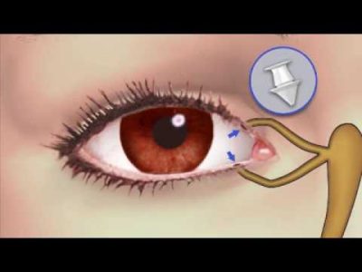 Videos - Boston Lasik-PRK-Laser Eye Surgery-Lasek-Intralase